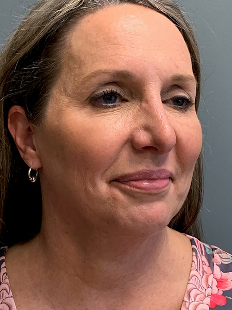 Rhinoplasty Before & After Gallery - Patient 124956 - Image 4