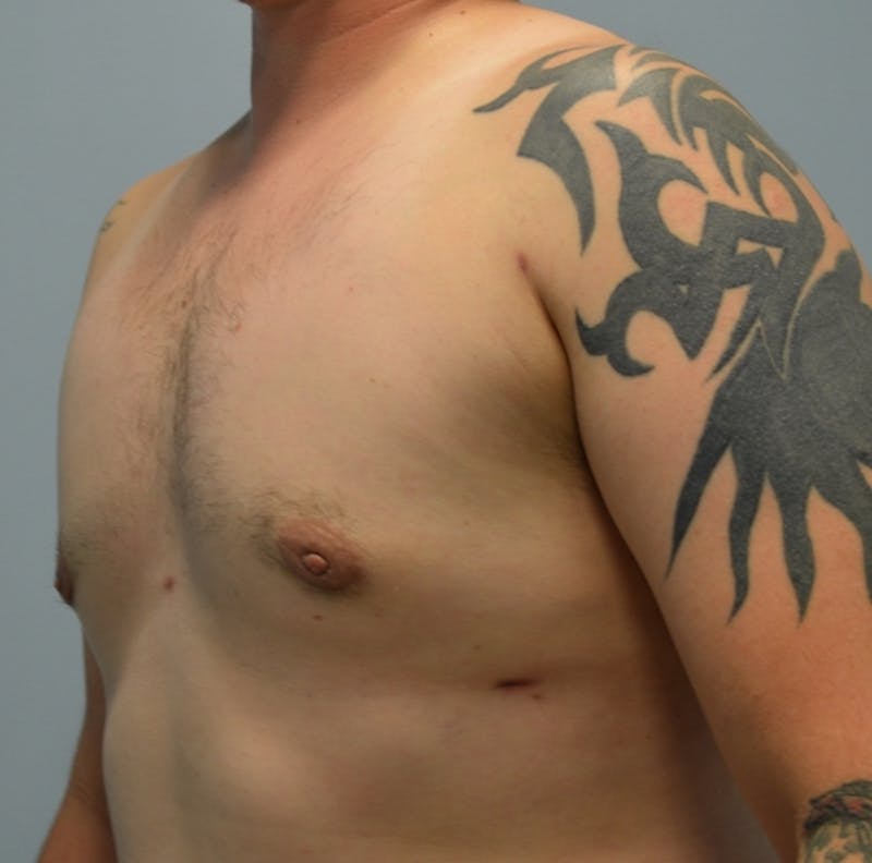Male Breast (Gynecomastia) Before & After Gallery - Patient 365568 - Image 4