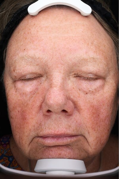 Lasers & Light Before & After Gallery - Patient 336060 - Image 1