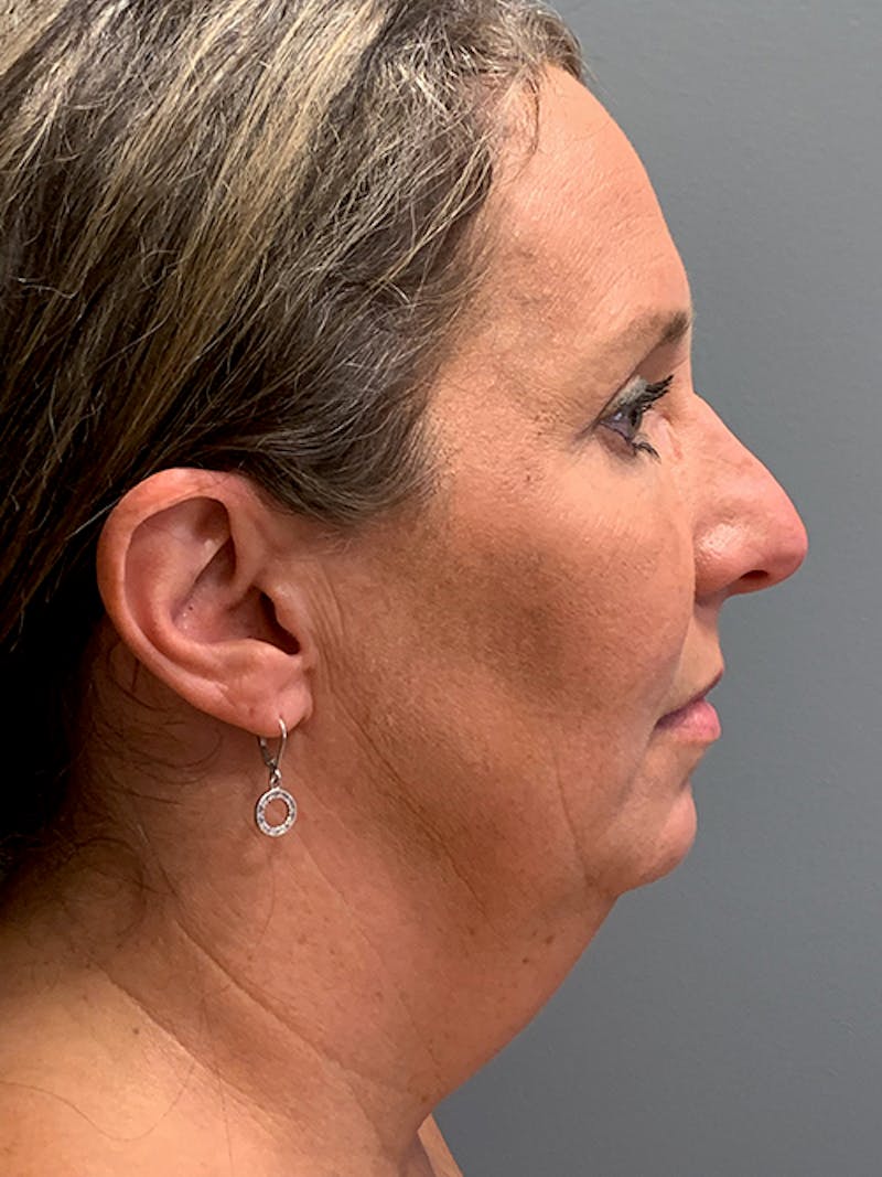 Rhinoplasty Before & After Gallery - Patient 124956 - Image 5