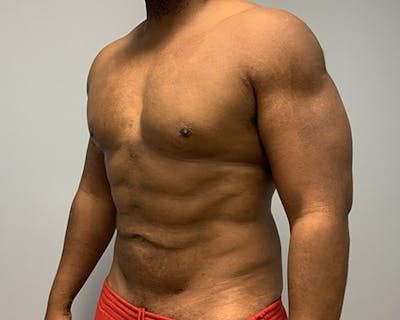 Hi Def Liposuction Before & After Gallery - Patient 316762 - Image 2