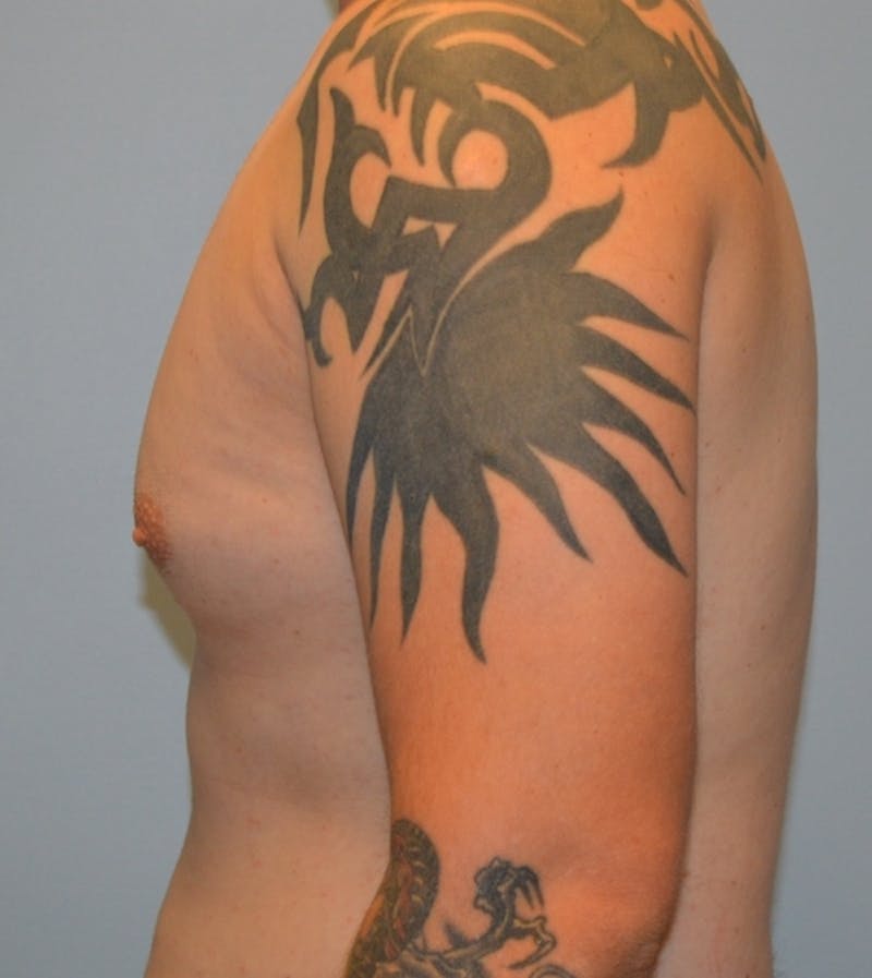 Male Breast (Gynecomastia) Before & After Gallery - Patient 365568 - Image 5