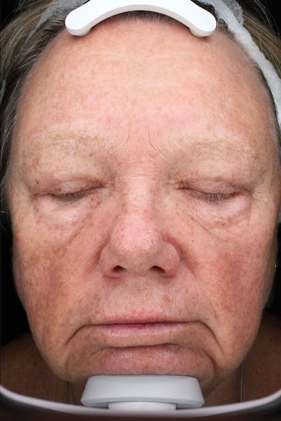 Lasers & Light Before & After Gallery - Patient 336060 - Image 2