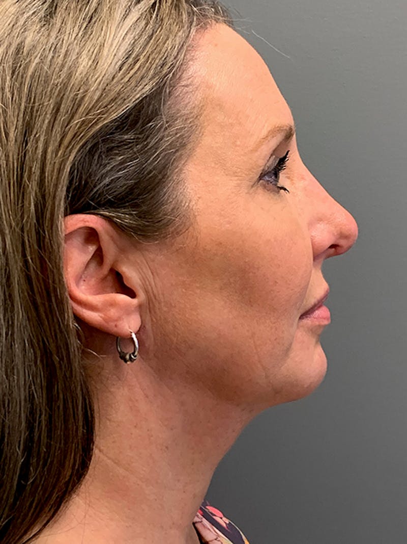Rhinoplasty Before & After Gallery - Patient 124956 - Image 6