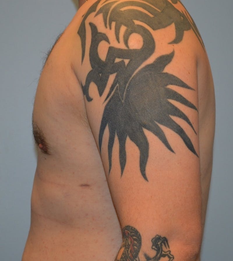 Male Breast (Gynecomastia) Before & After Gallery - Patient 365568 - Image 6