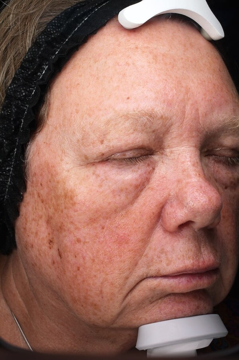 Lasers & Light Before & After Gallery - Patient 336060 - Image 3