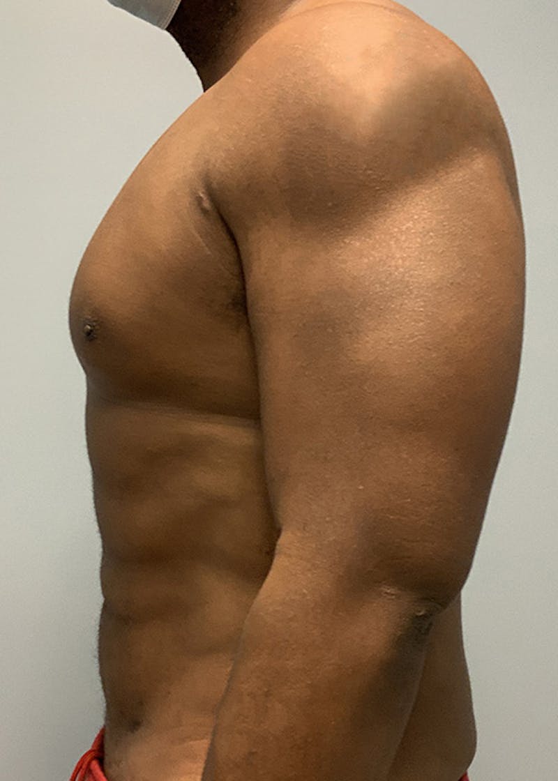 Hi Def Liposuction Before & After Gallery - Patient 316762 - Image 4