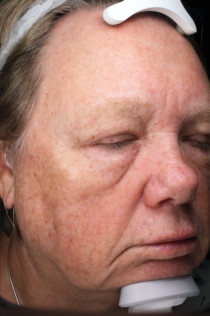 Lasers & Light Before & After Gallery - Patient 336060 - Image 4