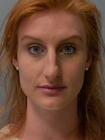 Rhinoplasty Before & After Gallery - Patient 135407 - Image 1