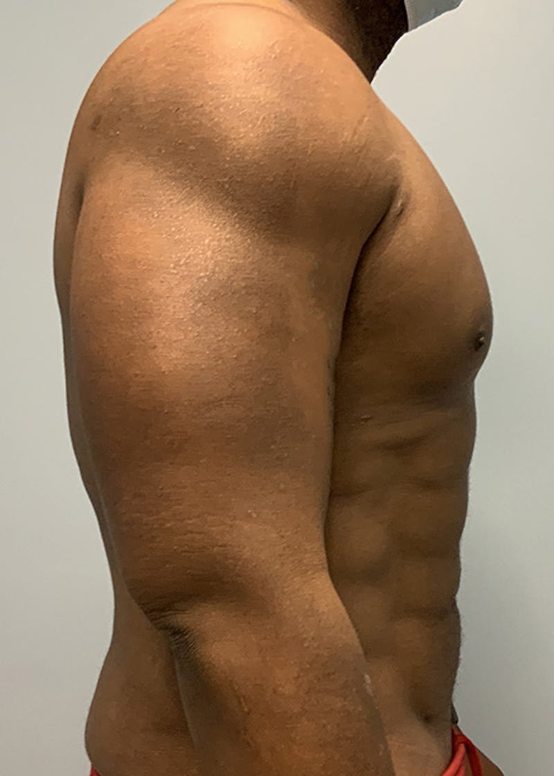 Hi Def Liposuction Before & After Gallery - Patient 316762 - Image 6