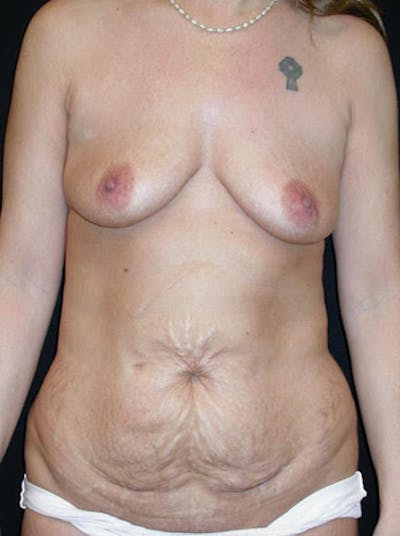 High Definition Mommy Makeover Before & After Gallery - Patient 175654 - Image 1