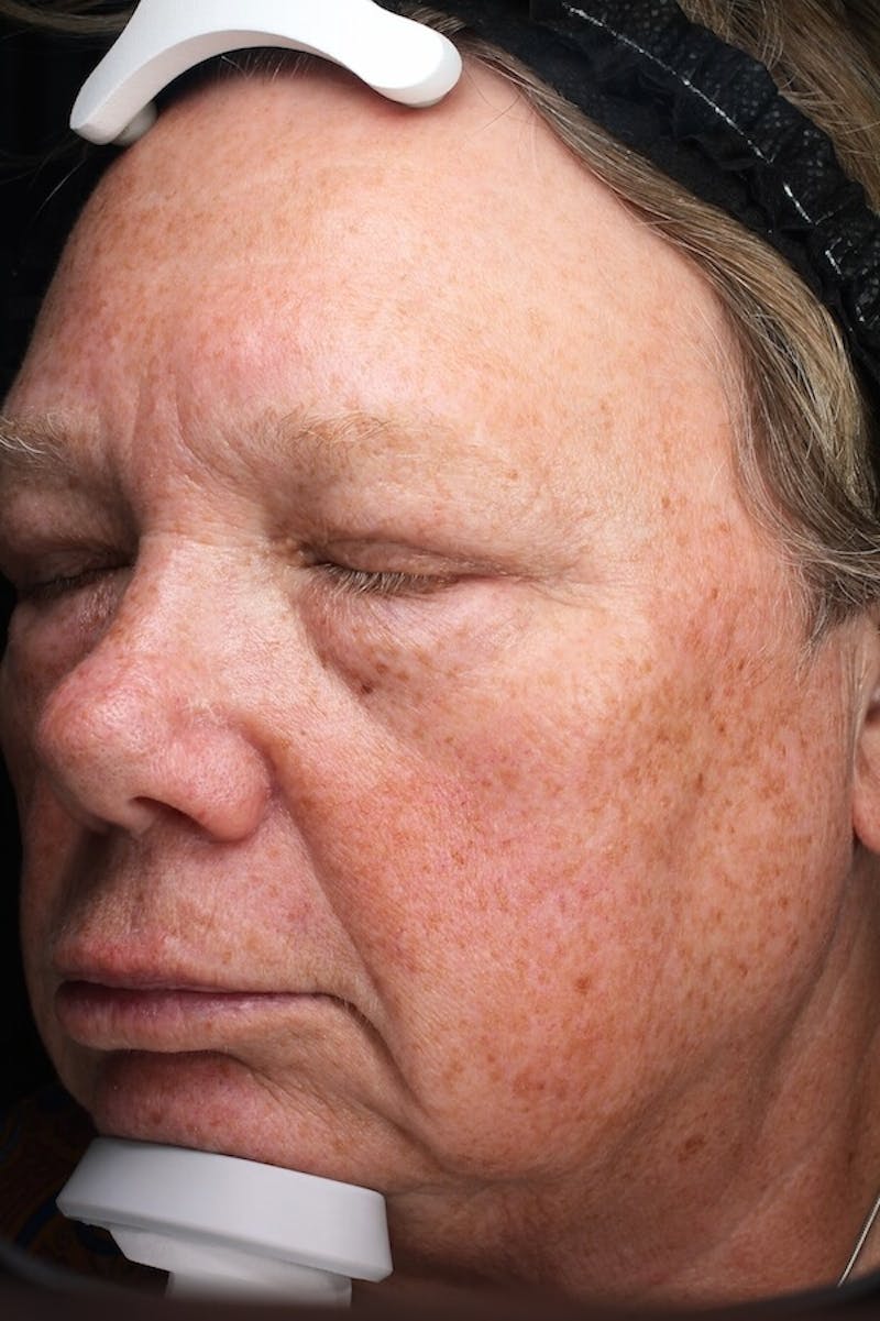 Lasers & Light Before & After Gallery - Patient 336060 - Image 5