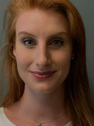 Rhinoplasty Before & After Gallery - Patient 135407 - Image 2