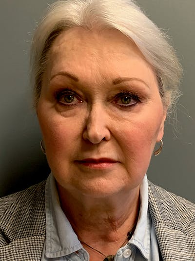 Deep Plane Facelift Before & After Gallery - Patient 243025 - Image 1