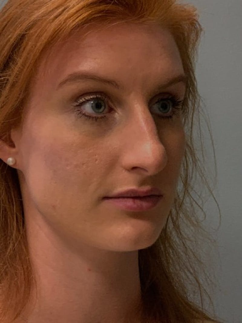 Rhinoplasty Before & After Gallery - Patient 135407 - Image 3