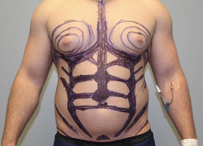 Hi Def Liposuction Before & After Gallery - Patient 159351 - Image 1