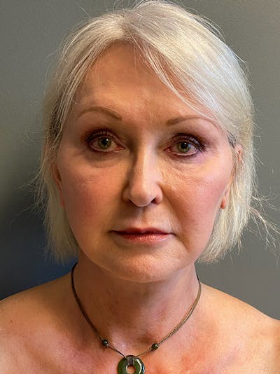 Deep Plane Facelift Before & After Gallery - Patient 243025 - Image 2