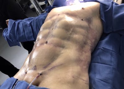 Hi Def Liposuction Before & After Gallery - Patient 159351 - Image 2