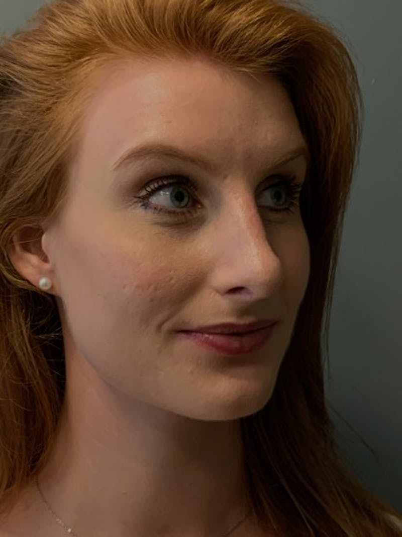 Rhinoplasty Before & After Gallery - Patient 135407 - Image 4