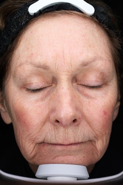 Lasers & Light Before & After Gallery - Patient 388034 - Image 1