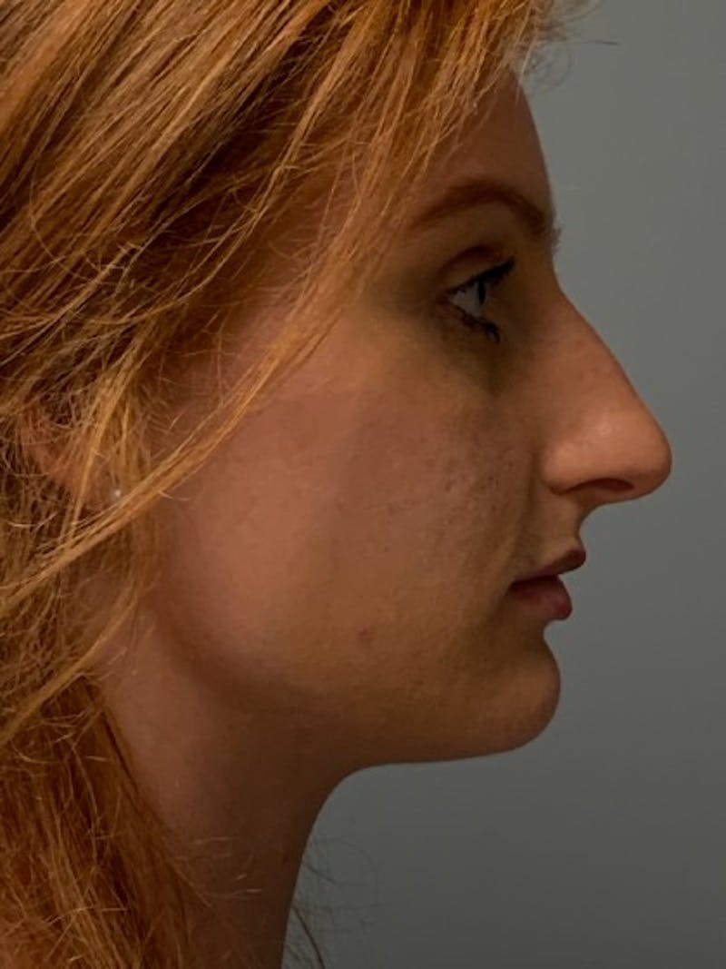 Rhinoplasty Before & After Gallery - Patient 135407 - Image 5
