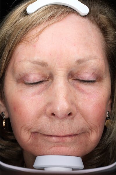 Lasers & Light Before & After Gallery - Patient 388034 - Image 2