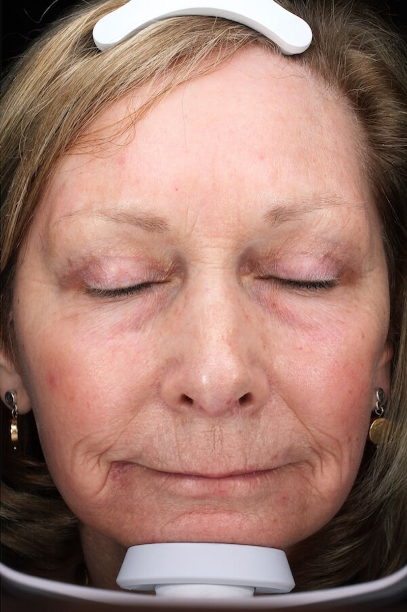Lasers & Light Before & After Gallery - Patient 388034 - Image 2