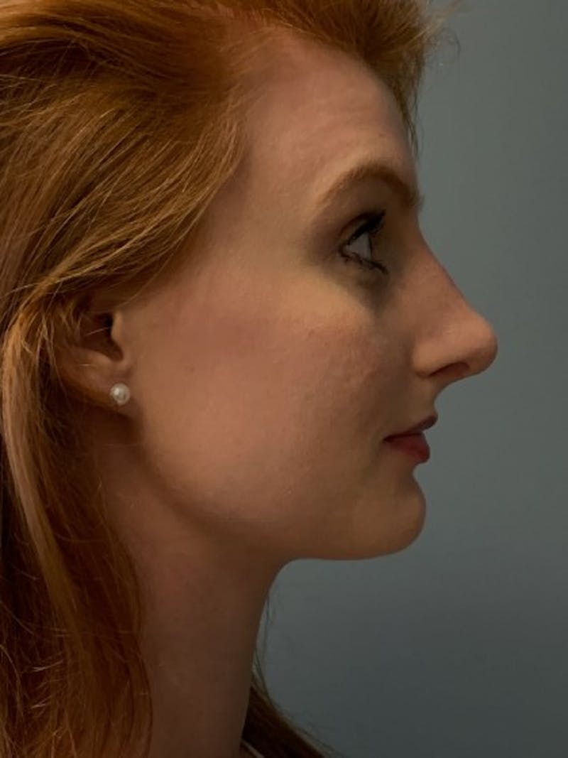 Rhinoplasty Before & After Gallery - Patient 135407 - Image 6