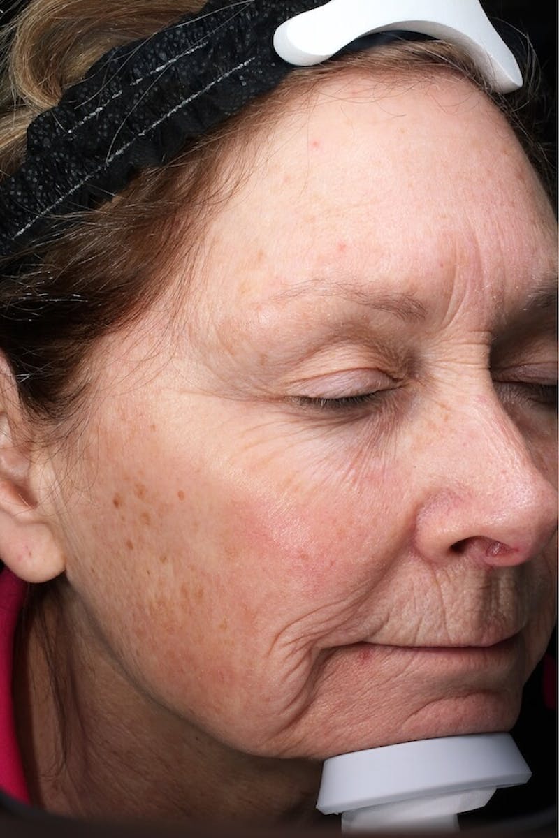 Lasers & Light Before & After Gallery - Patient 388034 - Image 3