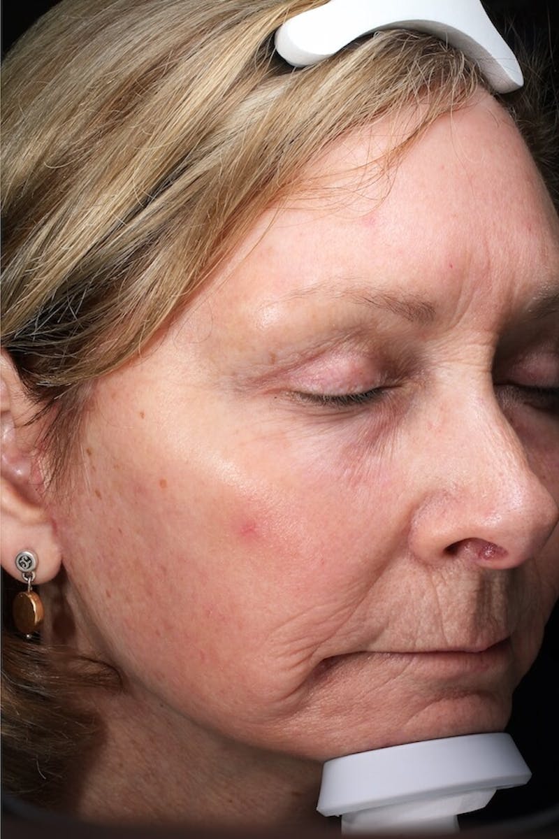 Lasers & Light Before & After Gallery - Patient 388034 - Image 4