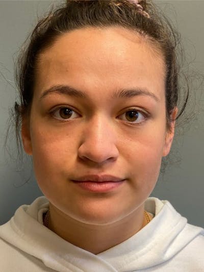 Rhinoplasty Before & After Gallery - Patient 344960 - Image 1