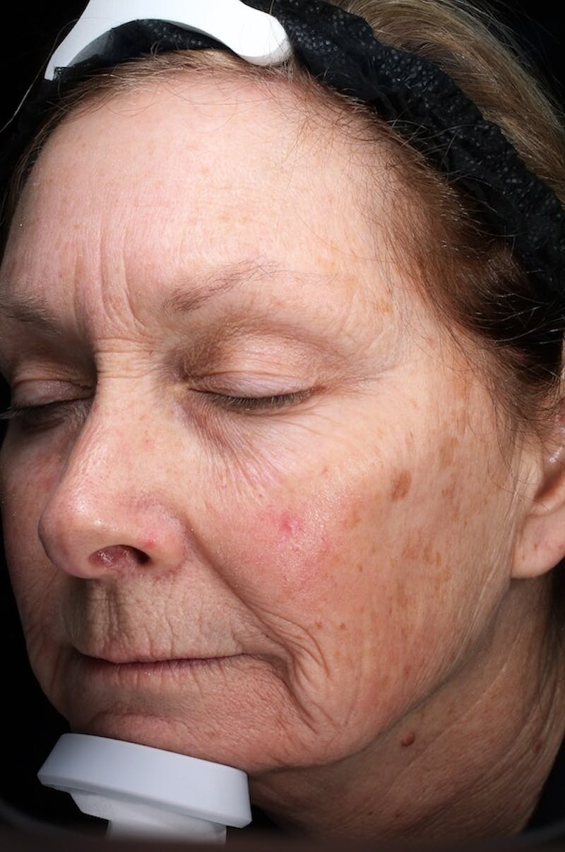 Lasers & Light Before & After Gallery - Patient 388034 - Image 5