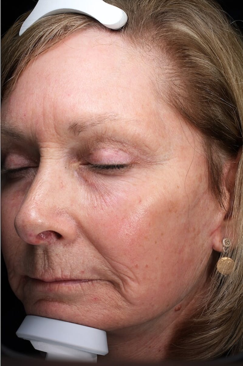 Lasers & Light Before & After Gallery - Patient 388034 - Image 6