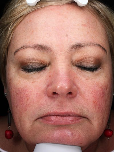 Lasers & Light Before & After Gallery - Patient 127331 - Image 1