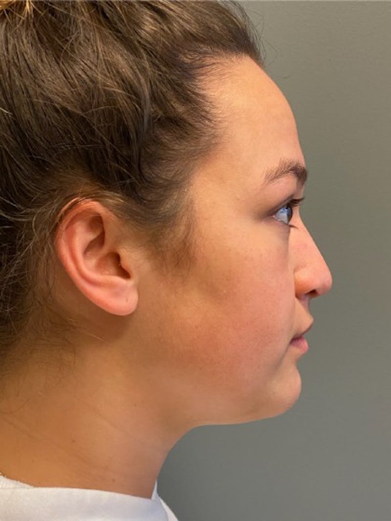 Rhinoplasty Before & After Gallery - Patient 344960 - Image 5