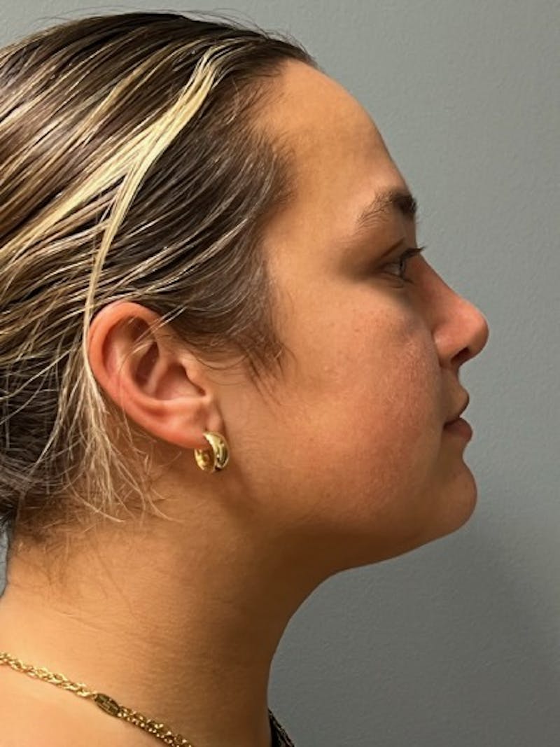 Rhinoplasty Before & After Gallery - Patient 344960 - Image 6