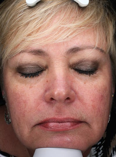 Lasers & Light Before & After Gallery - Patient 127331 - Image 2