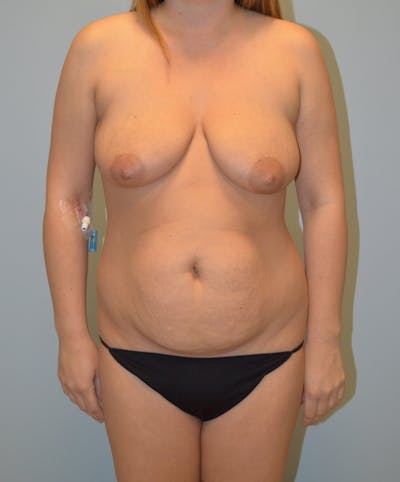 High Definition Mommy Makeover Before & After Gallery - Patient 298450 - Image 1