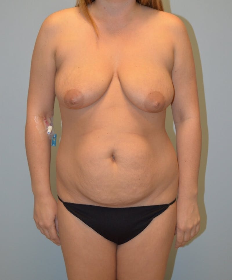 High Definition Mommy Makeover Before & After Gallery - Patient 298450 - Image 1
