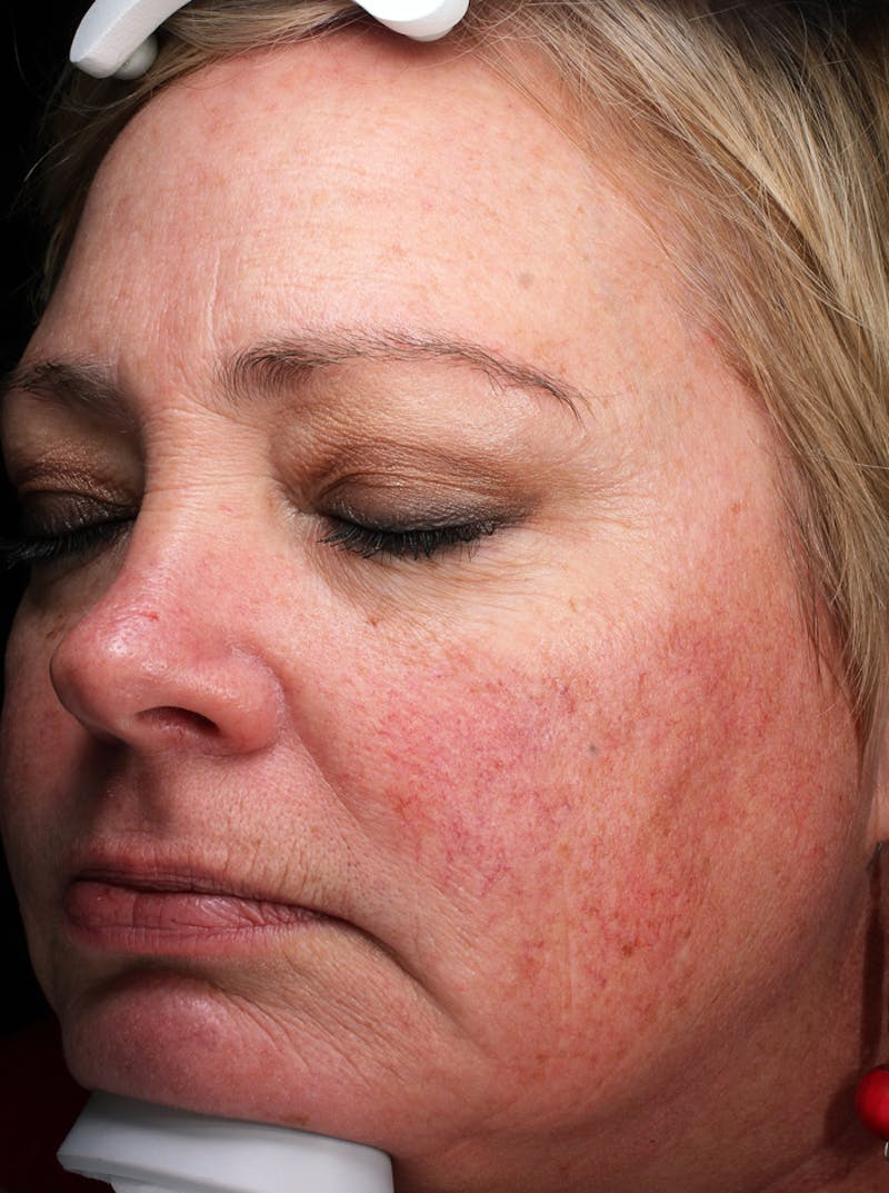 Lasers & Light Before & After Gallery - Patient 127331 - Image 3