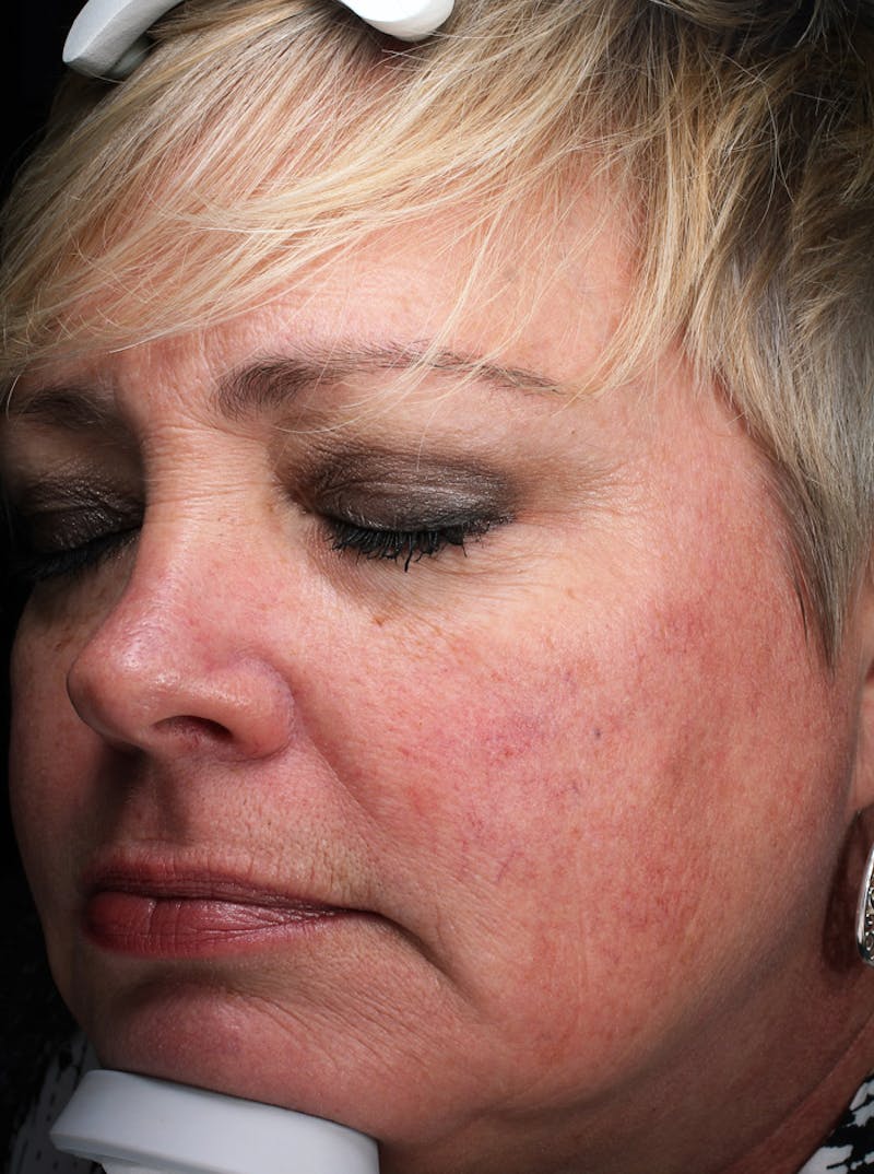 Lasers & Light Before & After Gallery - Patient 127331 - Image 4