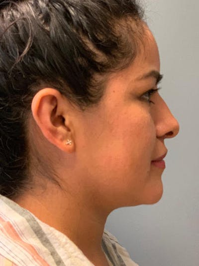 Rhinoplasty Before & After Gallery - Patient 316164 - Image 1