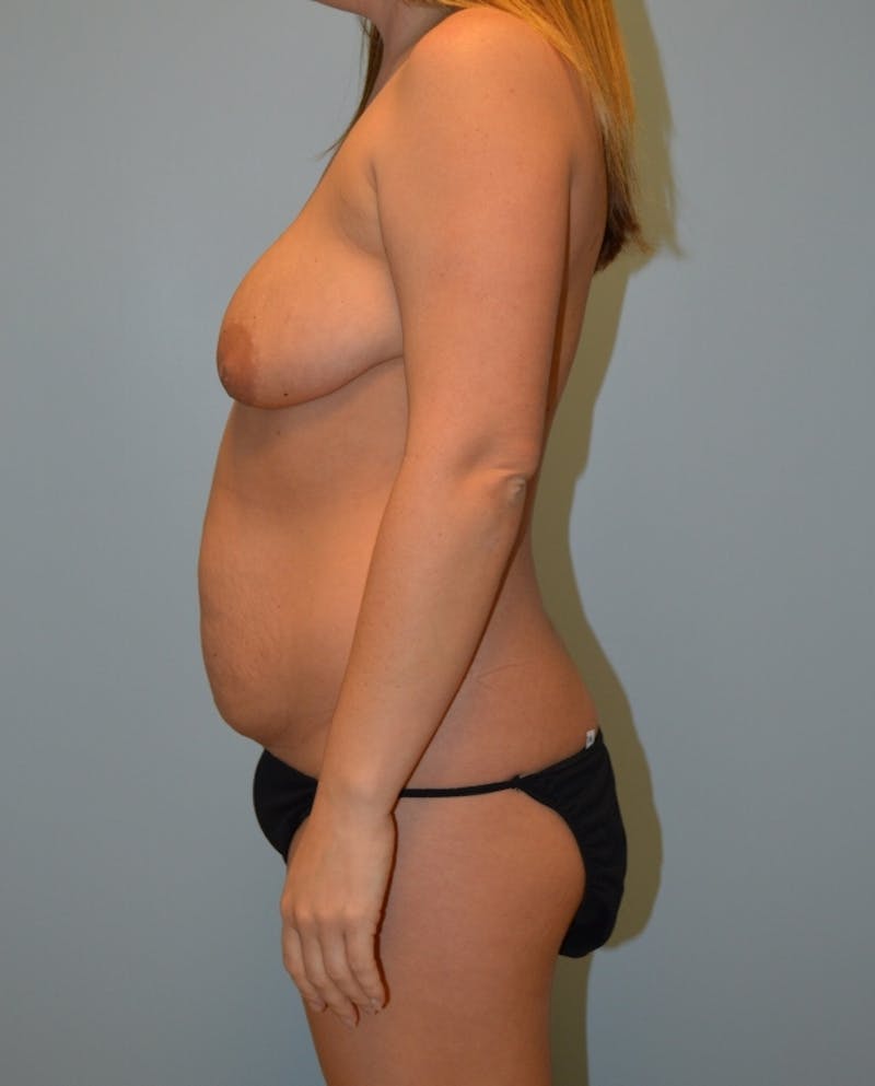 High Definition Mommy Makeover Before & After Gallery - Patient 298450 - Image 3