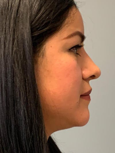 Rhinoplasty Before & After Gallery - Patient 316164 - Image 2