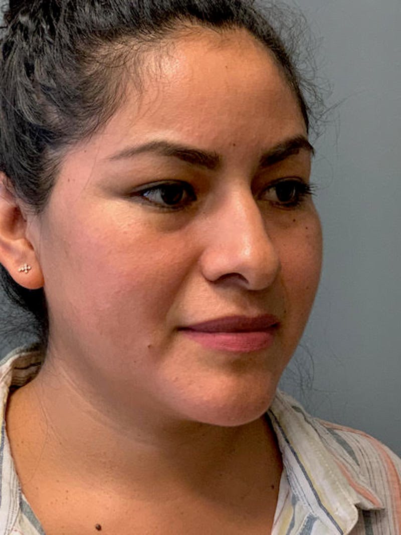 Rhinoplasty Before & After Gallery - Patient 316164 - Image 3