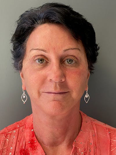 Deep Plane Facelift Before & After Gallery - Patient 643619 - Image 2