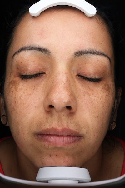 Lasers & Light Before & After Gallery - Patient 108454 - Image 1