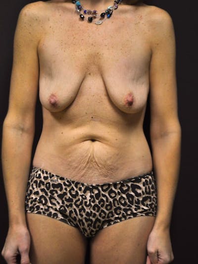 High Definition Mommy Makeover Before & After Gallery - Patient 264019 - Image 1