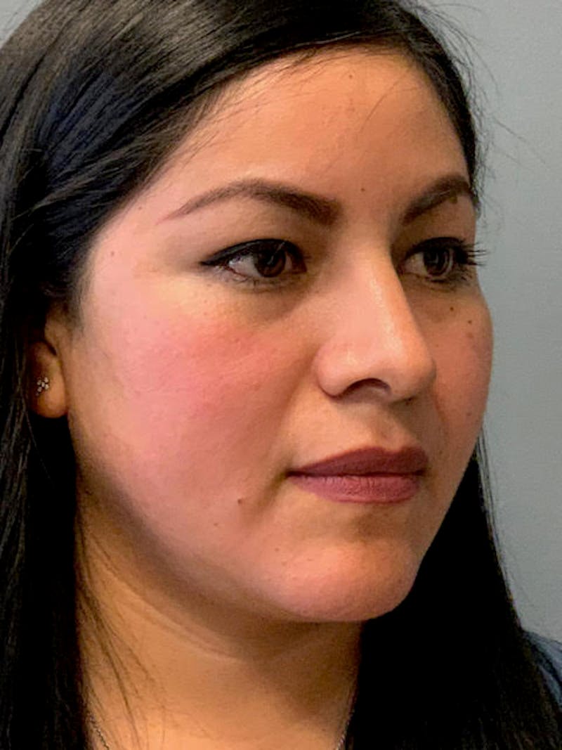 Rhinoplasty Before & After Gallery - Patient 316164 - Image 4