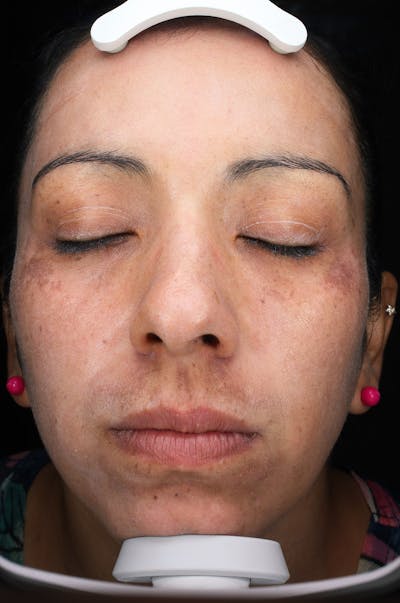Lasers & Light Before & After Gallery - Patient 108454 - Image 2